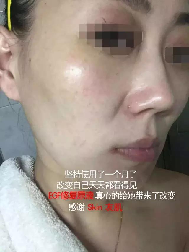 友肌EGF修复原液使用后