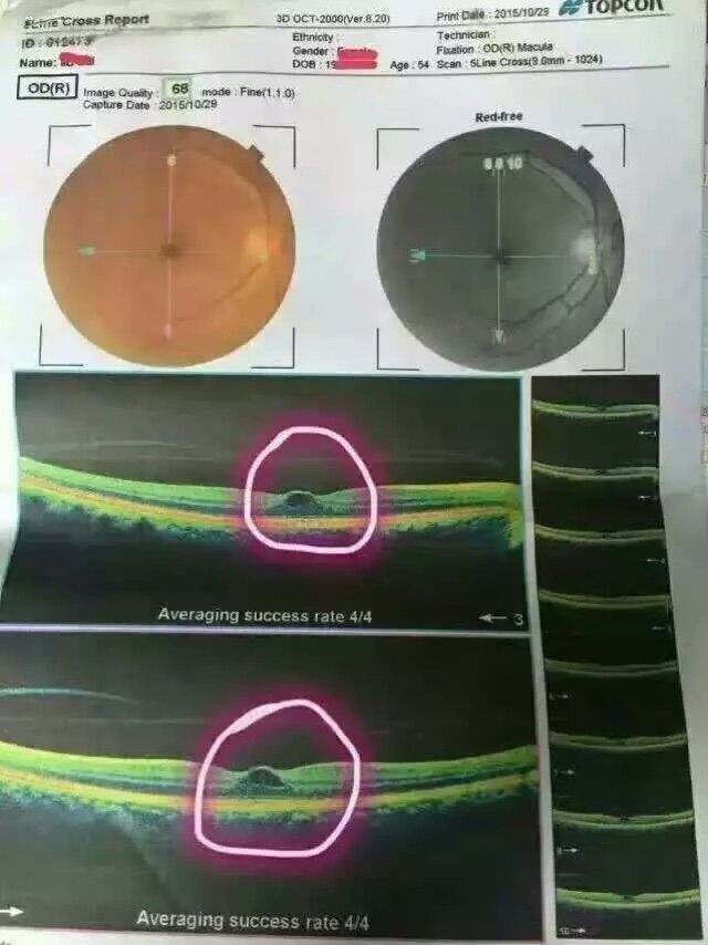 黄金视力眼贴反馈